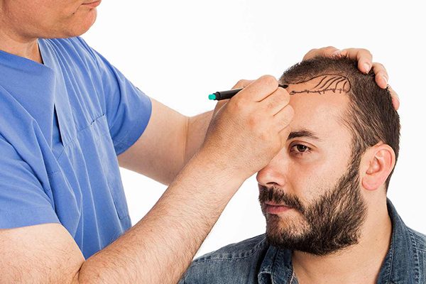 fue hair transplant