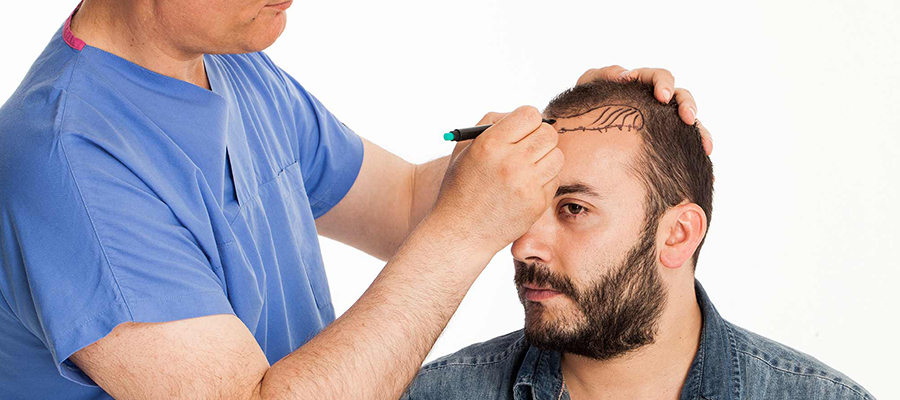 fue hair transplant